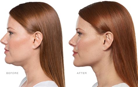 belkyra behandeling|Belkyra/Kybella: de eerste injectable.